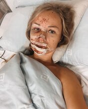  Gorgeous German Influencer Lucky To Be Alive After Crash That Broke Her Back In Four Places